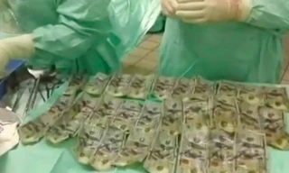 Số tiền mệnh giá 100 USD lấy từ dạ dày và ruột của nữ bệnh nhân Colombia.