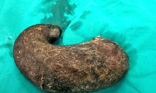 Khối tóc kết nặng hơn 1kg trong bụng bệnh nhân 15 tuổi. 