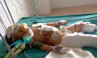 Cháu bé nạn nhân vụ nổ xe máy đang nguy kịch