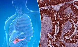 Tỷ lệ tử vong vì ung thư tuyến tụy tăng nhanh ở phụ nữ dưới 55 tuổi