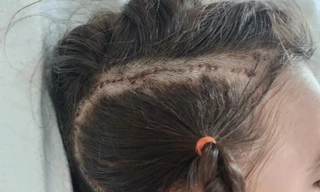 Kỳ diệu phương pháp điều trị viêm não cho bé gái 6 tuổi 