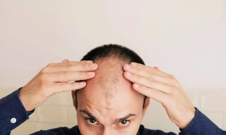 Tại sao đàn ông hay bị hói ở đỉnh đầu và cách chữa trị 