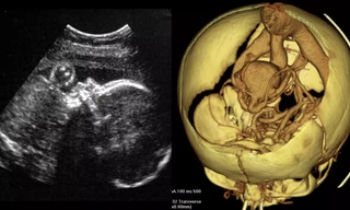 Thực hiện ca phẫu thuật não đầu tiên với thai nhi trong bụng mẹ 