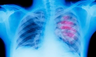 Không hút thuốc lá vẫn có nguy cơ cao mắc ung thư phổi? 