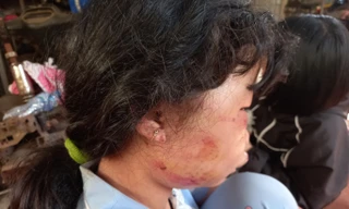 Nữ sinh lớp 6 kinh hoàng nhớ lại phút bị người lạ đánh dã man trong lô cao su