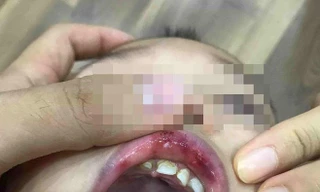 Điểm nhấn giáo dục: Cô giáo ở Hà Nội tát trẻ bầm dập, tụ máu môi