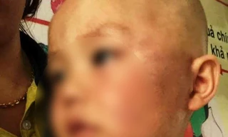 Vết bầm vẫn đang chiếm hết phần mặt của bé Huy