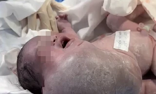 Bé trai vừa chào đời đã đối mặt với nguy cơ tử vong vì khối bướu khổng lồ hiếm gặp 