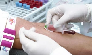 Kinh ngạc ống xét nghiệm máu của bệnh nhân hơn một nửa là mỡ