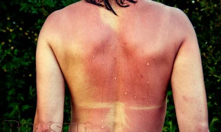 Cháy nắng: Con đường nhanh nhất dẫn đến ung thư da