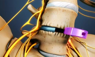 Phương pháp phẫu thuật thay thế đốt sống bằng vật liệu mới