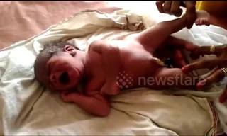 Em bé ra đời với 4 chân gây kinh ngạc