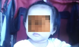 Bé T. vừa được các bác sĩ gắp ra một viên đá bằng đầu đũa nằm mắc kẹt trong mũi. Ảnh: Thanh Lâm