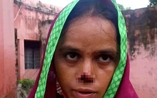 Chồng cắt mũi vợ vì không ‘cống nộp’ đủ tiền hồi môn