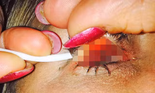 Sử dụng mascara trong thời gian dài đã khiến một người phụ nữ ở Australia suýt bị mù mắt.