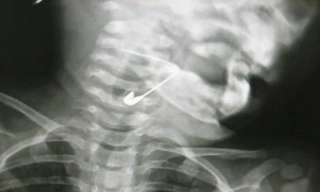 Cây kim băng được phát hiện trong thanh quản cháu bé trong tư thế mở