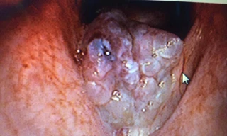 Nữ sinh 23 tuổi cắt u nhú thanh quản 22 lần 