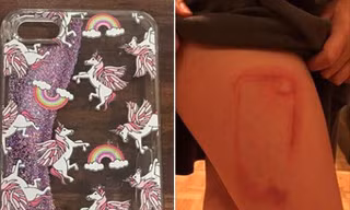 Những trường hợp bỏng da do ốp điện thoại