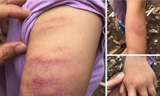 Cảnh cáo cô giáo đánh bầm tay học sinh