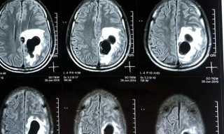 Sán làm tổ như chùm nho trong não vì nghiện món tiết canh