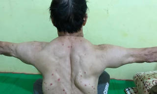 Người đàn ông với những khối u lạ mọc chi chít khắp người. Ảnh: BV cung cấp