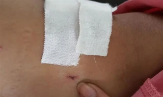 Vết khoan 'nhầm' của BS đối với bệnh nhân bị gãy đốt sống ngực