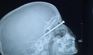 Dị vật đâm xuyên mắt em A.T. đã được lấy ra