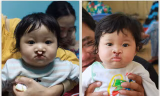 Cháu Khưu Kim Châu trước và sau khi được phẫu thuật. 