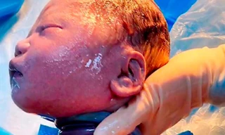 Phép màu y học khi một em bé sinh ra với dây rốn quấn cổ 6 vòng vẫn sống sót