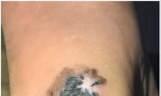 Đốm đen ở gót chân trở thành ung thư da 