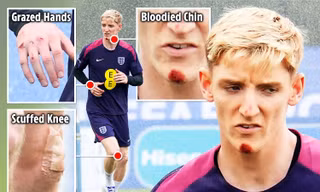 Ngôi sao tuyển Anh ‘te tua’, suýt thiệt mạng vì ngã xe đạp