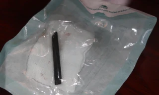 Ẩu đả với bạn, chiếc đũa 'mắc kẹt' trong hốc mắt người đàn ông suốt 4 năm