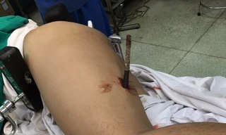 Trượt té tại công trường, nam công nhân bị thanh sắt đâm xuyên đùi