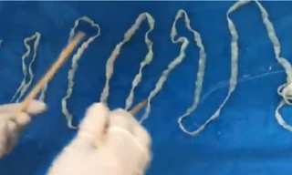 Kinh hãi con sán dài 5,2 mét ký sinh trong bụng cô gái
