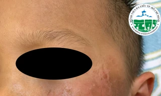 Bé trai 4 tuổi da bỏng rộp vì đồ chơi Halloween