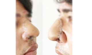 Đầu mũi bị chém bay được tái tạo “'thần kỳ' nhờ da cẳng tay