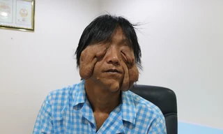 Mang khối u khổng lồ như 'mặt quỷ', người đàn ông 17 năm không dám ra khỏi nhà