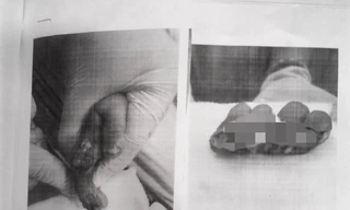 Bé trai 1 tuổi mất 4 ngón tay vì người lớn lơ là