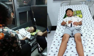 Bác sĩ thắt thòng lọng nội soi gắp que kẹo mút ra khỏi họng em bé