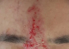 Mù mắt vì tiêm filler nâng mũi