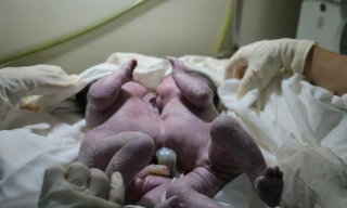 Phẫu thuật thành công ca sinh đôi dính chặt gan