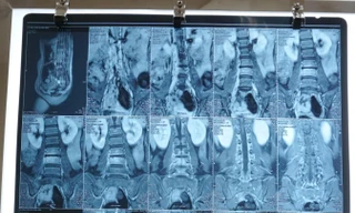 Đùa giỡn va cột sống vào cạnh bàn, bé gái suýt chết vì căn bệnh hiếm gặp