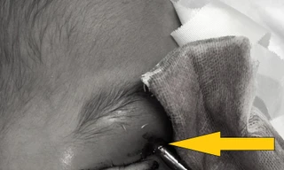 Cứu sống ngoạn mục bé trai bị thanh sắt đâm xuyên não