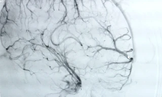 Nôn ói cứ ngỡ trúng thực, bệnh nhân suýt chết vì xuất huyết não