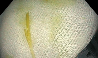 Que tăm đâm thủng tá tràng người phụ nữ