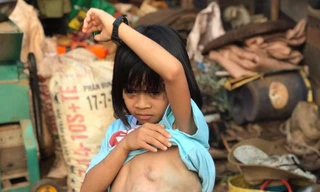 Phẫu thuật thành công cho bé gái 8 năm cõng khối bướu 4 kg trên lưng