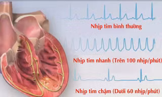 Bé gái mắc bệnh hiếm khiến tim đập nhanh 200 lần/ phút