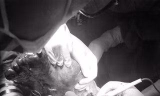 Lấy thành công khối đa nang lách dài nửa mét trong bụng người phụ nữ