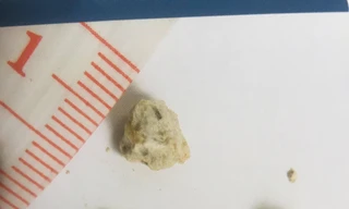 Ăn mặn, ít uống nước là đang ‘nuôi’ sỏi niệu