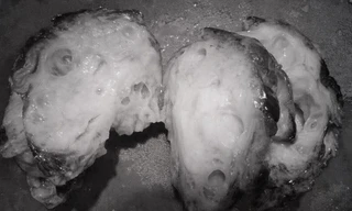 Bé trai có khối bướu to như quả bưởi trên mặt